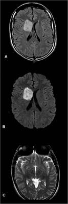 The Need to Look for Visual Deficit After Stroke in Children